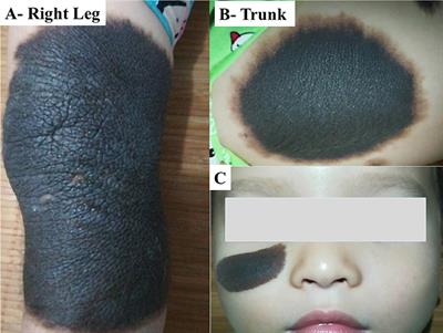 Neurocutaneous Melanosis in Association With Large Congenital Melanocytic Nevi in Children: A Report of 2 Cases With Clinical, Radiological, and Pathogenetic Evaluation